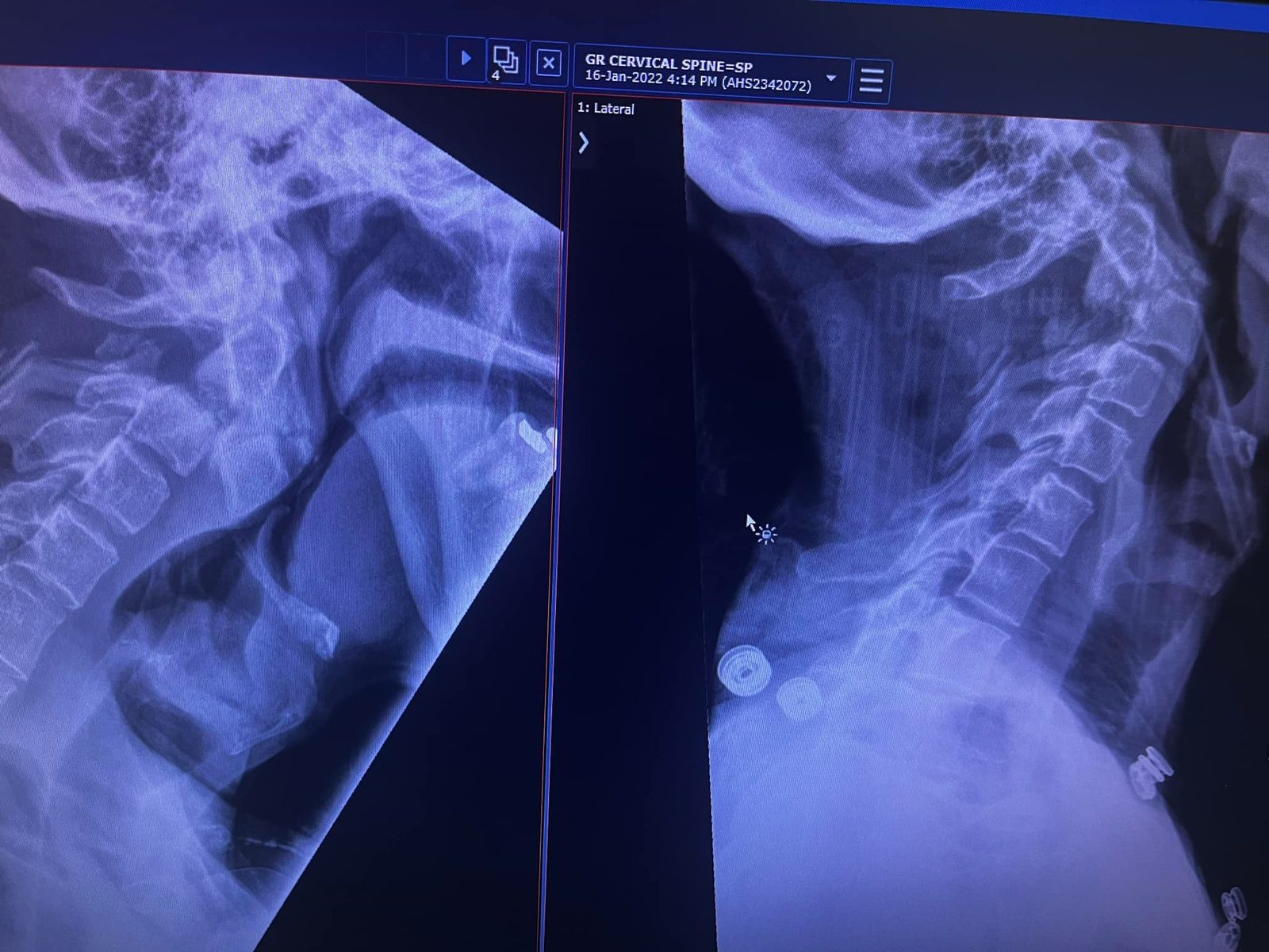 After the neck broke.