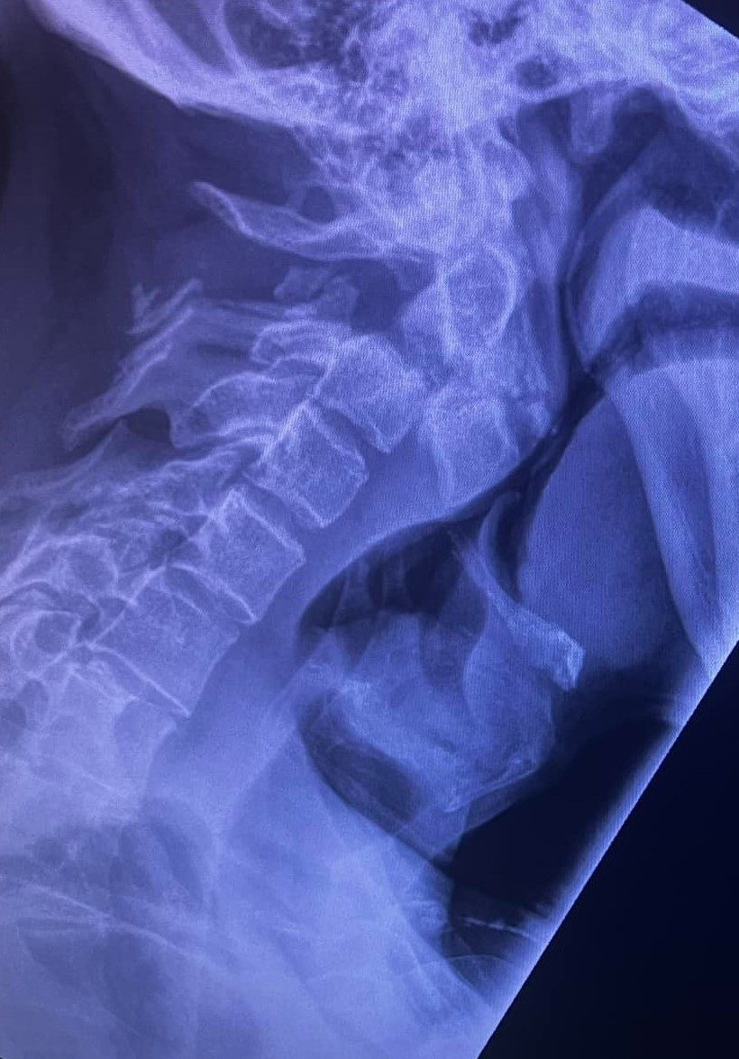 The broken neck.