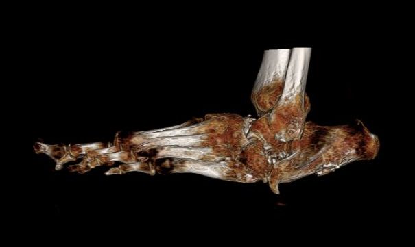 The foot.