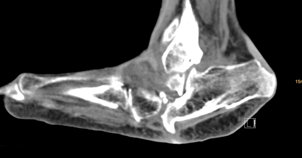 CT: the bone hook under my foot.