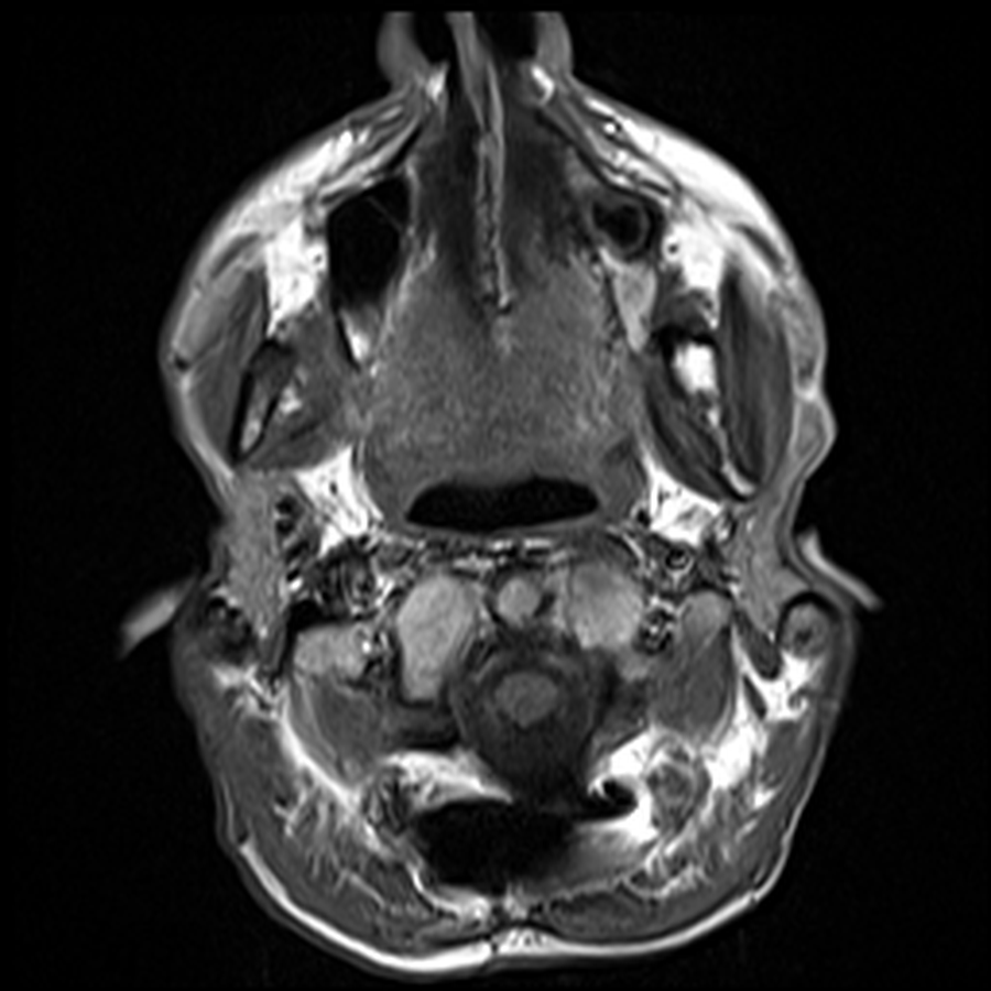 Axial T1 MRI through the mandible showing cervical fusion hardware