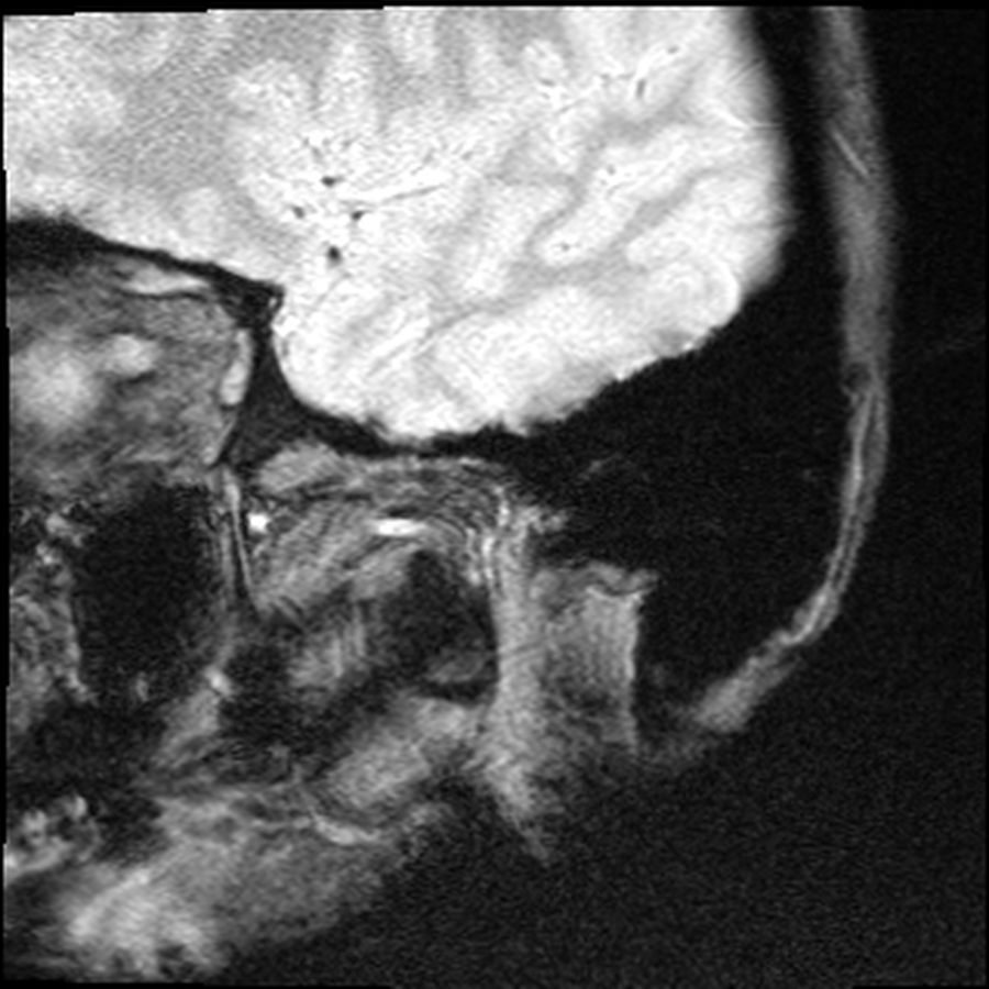 Sagittal MRI showing erosion of the right jaw condyle