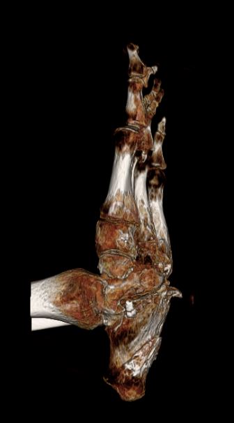 Foot showing a bone spike on the underside