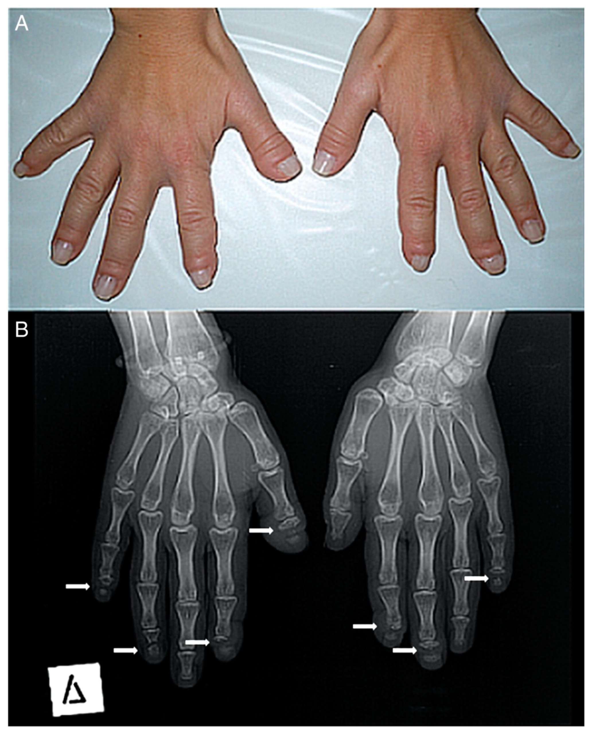 Hands beside an X-ray showing acro-osteolysis at the fingertips