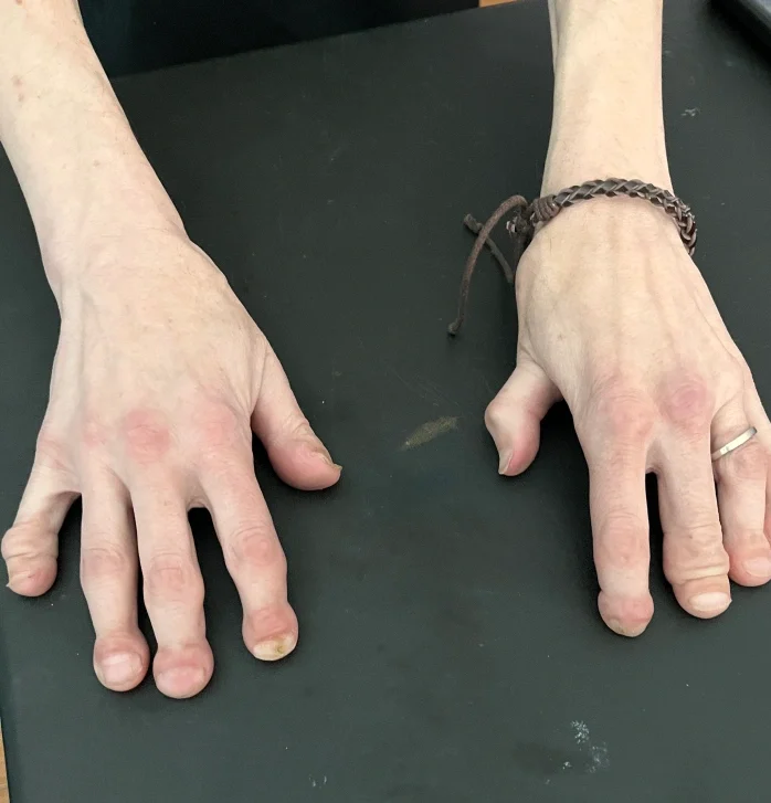 Both hands showing acro-osteolysis at the fingertips