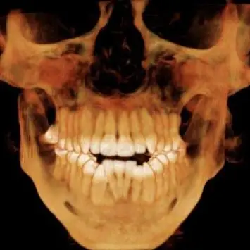 CT scan showing osteolysis of the jaw bones