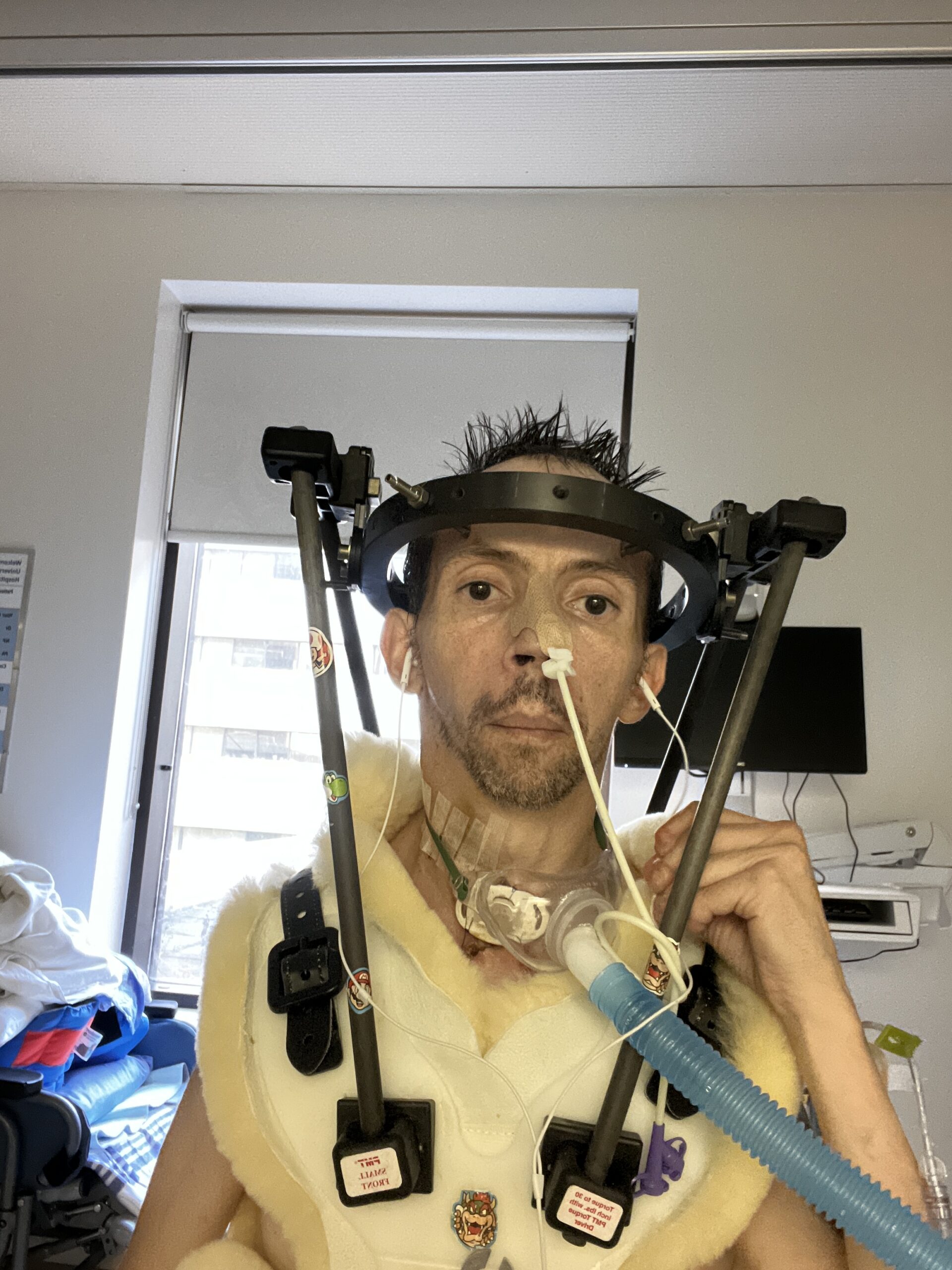 In a halo brace after cervical spinal fusion