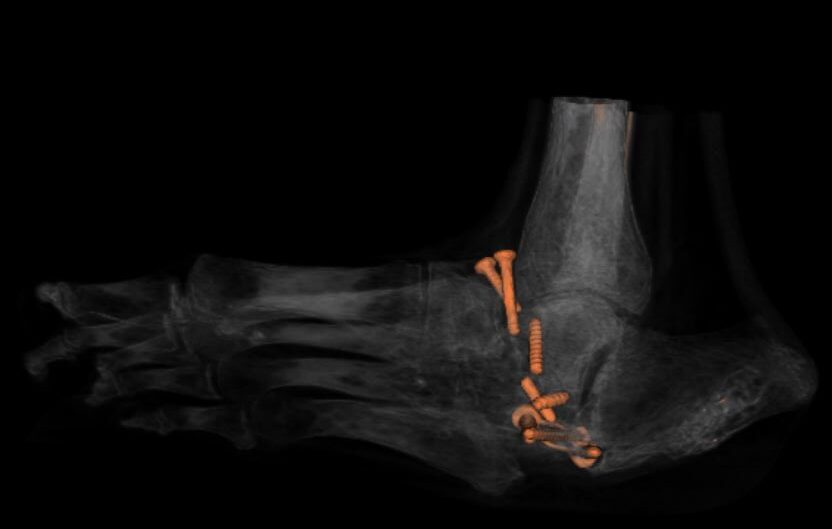 Foot X-ray showing a broken surgical screw